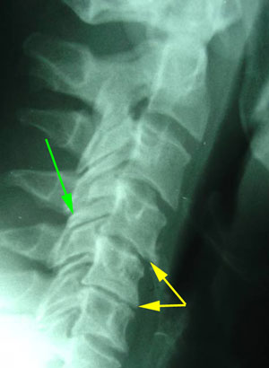 disc degeneration treated at Arctic Chiropractic, Sitka