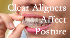 Clear aligners influence posture which Sitka chiropractic helps.