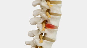 Sitka chiropractic conservative care helps even huge disc herniations go away