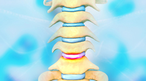Sitka disc degeneration health