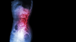 Sitka Chiropractic Care of Spondylolisthesis 