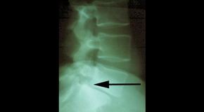 Sitka spondylolisthesis 