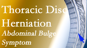 Arctic Chiropractic, Sitka treats thoracic disc herniation that for some patients prompts abdominal pain.