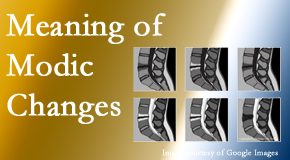 Arctic Chiropractic, Sitka sees many back pain and neck pain patients who bring their MRIs with them to the office. Modic changes are often seen. 