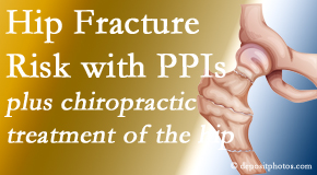 Arctic Chiropractic, Sitka shares new research describing increased risk of hip fracture with proton pump inhibitor use. 