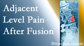 Arctic Chiropractic, Sitka offers relieving care non-surgically to back pain patients experiencing adjacent level pain after spinal fusion surgery.