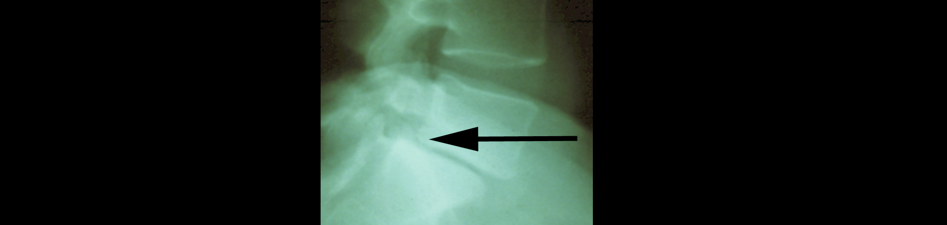 Sitka spondylolisthesis 