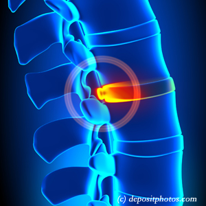 picture of lumbar Sitka disc herniation
