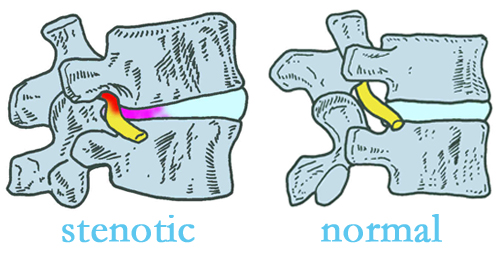 Sitka stenotic and normal spinal discs